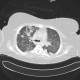 Aspergilosis of lung, crescent sign: CT - Computed tomography